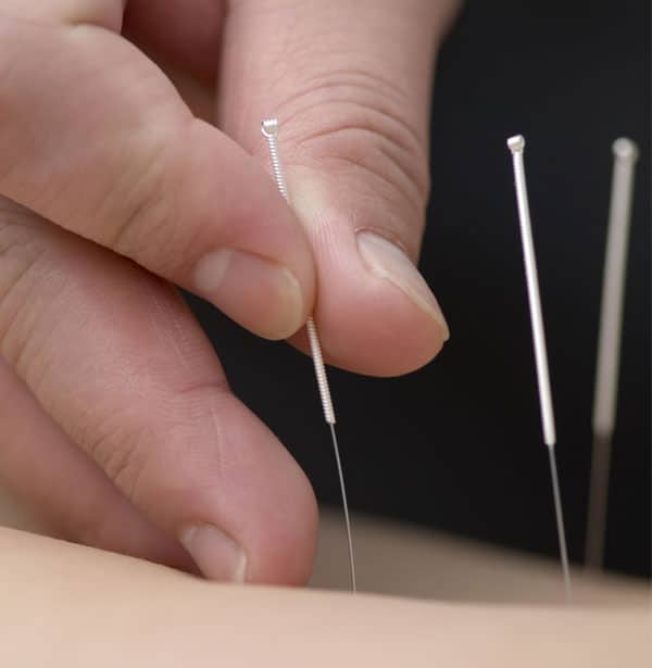 Acupuncture Services NJ